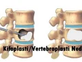 Kifoplasti/vertebroplasti nedir