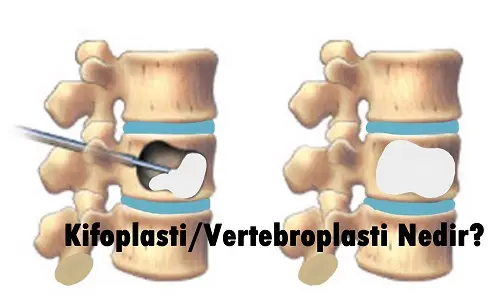 Kifoplasti/vertebroplasti nedir
