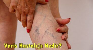 Varisli Damarlar Nedir ?