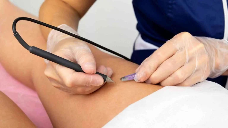 İğneli Epilasyon Nedir