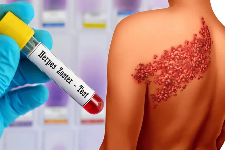 Zona hastalıgı nedir