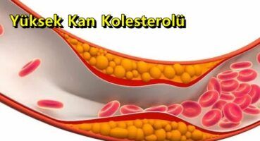 Yüksek Kan Kolesterolü