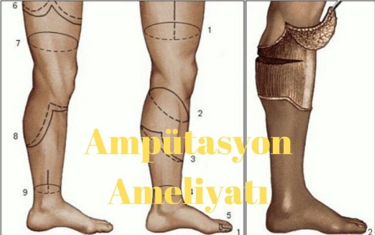 Ampütasyon Ameliyatı