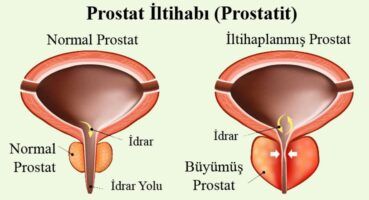 Prostatit Nedir ?