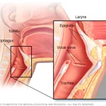 Epiglottit belirtileri