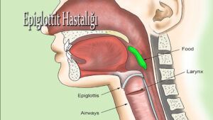 Epiglottit Hastalığı belirtileri