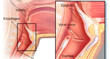 Epiglottit Belirtileri