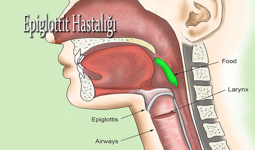 Epiglottit Hastalığı belirtileri