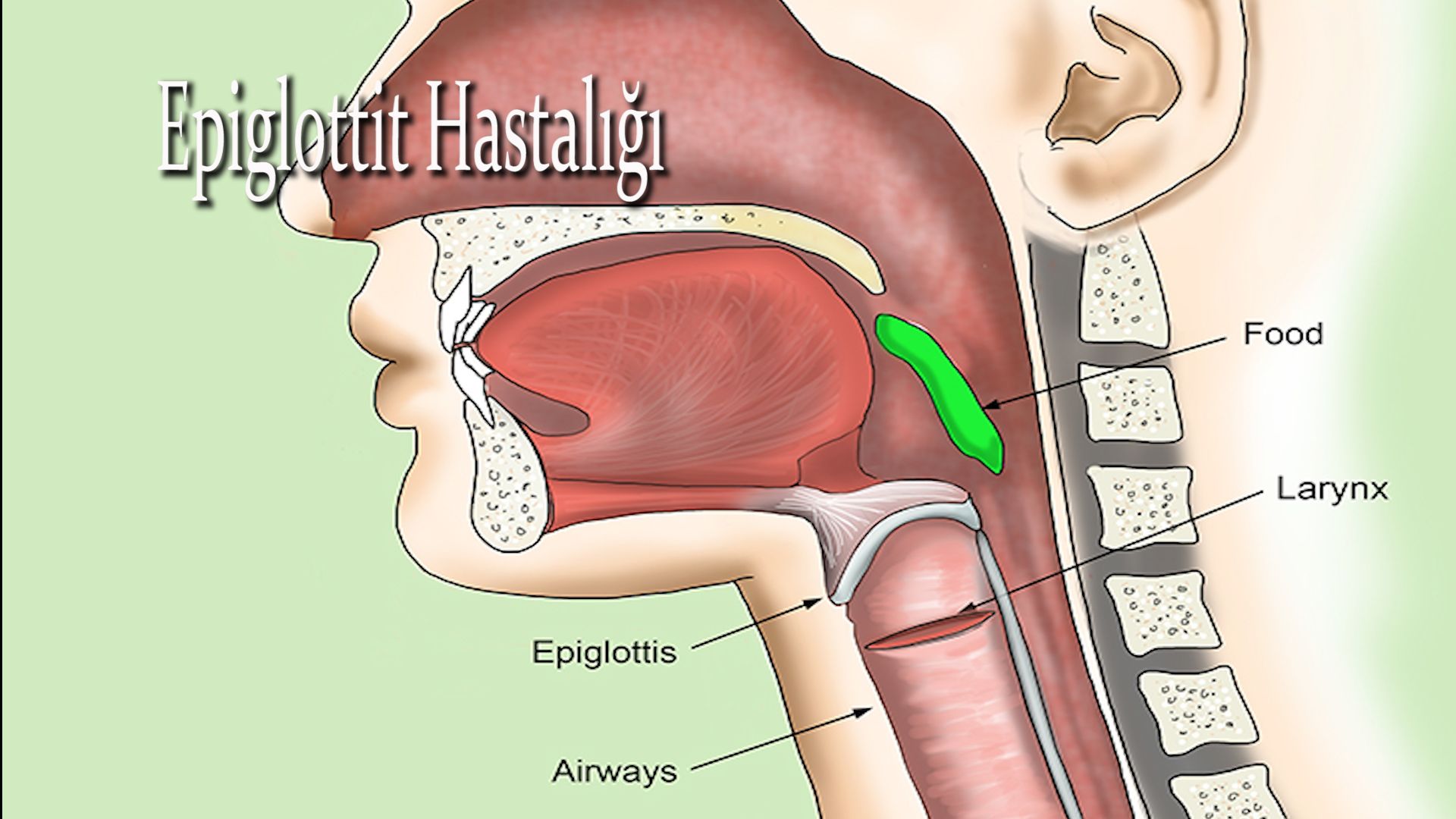 Epiglottit belirtileri