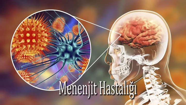 Menenjit Hastaligi nedir