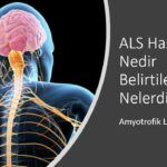 ALS Hastalığı Nedir Belirtileri Nelerdir