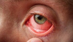 pempe göz hastalığı nedir