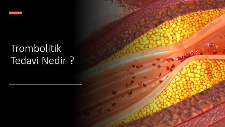 Trombolitik Tedavi Nedir