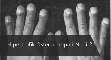 Hipertrofik osteoartropati nedir