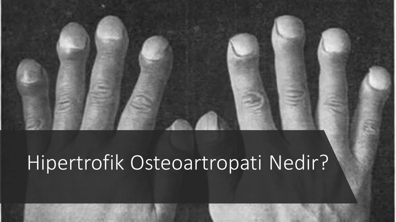 Hipertrofik osteoartropati nedir