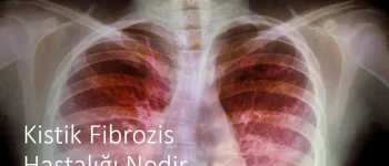 Kistik Fibrozis Hastalığı Nedir