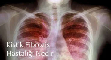 Kistik Fibrozis Hastalığı Nedir