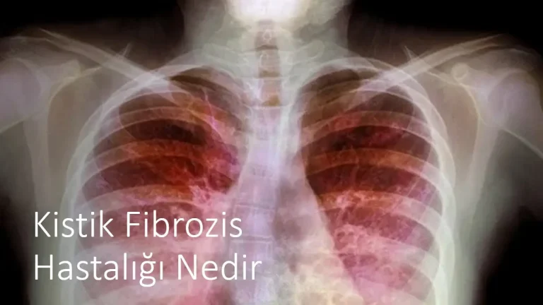 Kistik Fibrozis Hastalığı Nedir