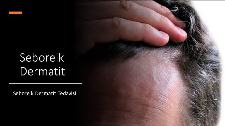 Seboreik Dermatit Tedavisi