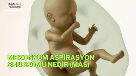 Mekonyum Aspirasyon Sendromu Nedir (MAS)