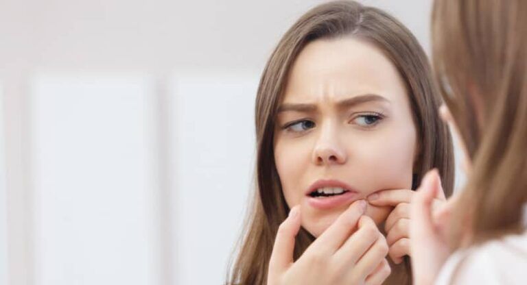 sivilceye ne iyi gelir