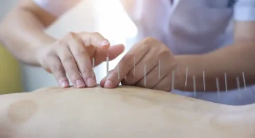 Detaylı Bir Bakışla Akupunktur: Nedir, Nasıl Yapılır ve Faydaları Nelerdir
