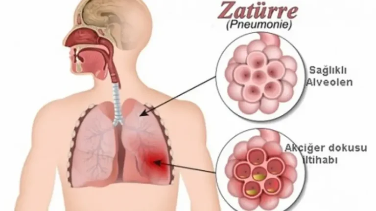 pnömoni (Zature) nedir