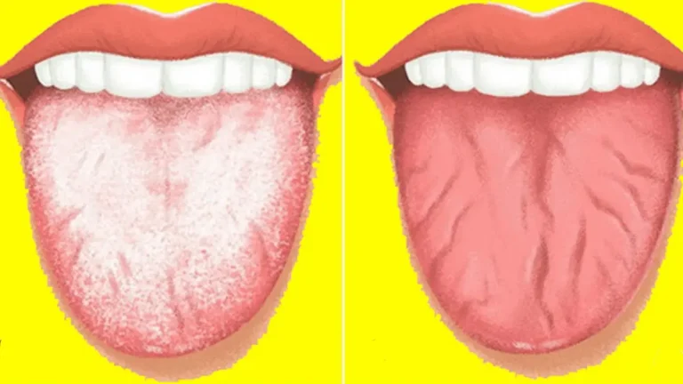 Dilin Beyazlama Sebebi