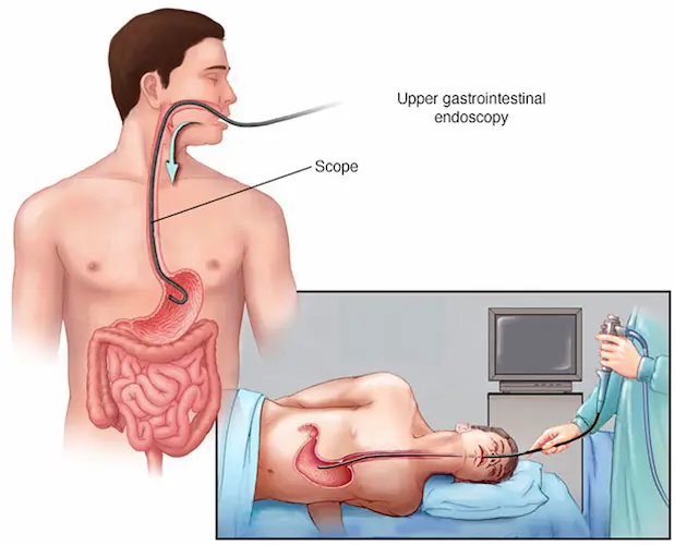 ERCP nedir