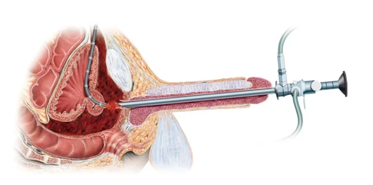 Transüretral Mesane Rezeksiyonu