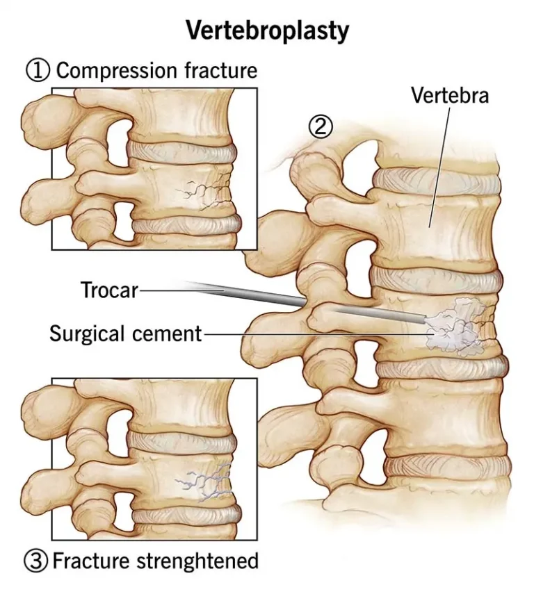 vertebroplasti nedir